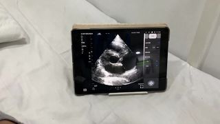 심장 및 POCUS용 듀얼 헤드 무선 초음파 프로브